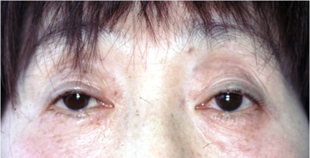 眼瞼挙筋短縮術 術後