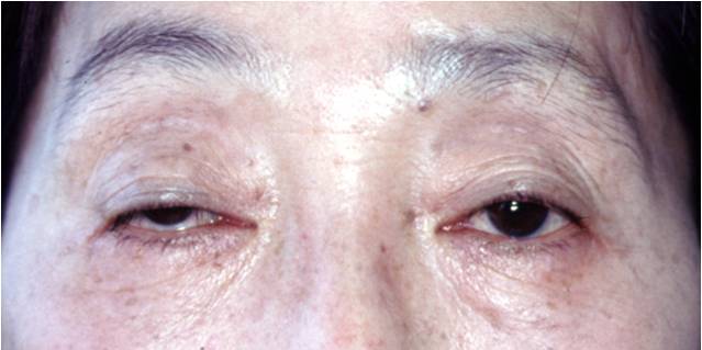 眼瞼挙筋短縮術 術前