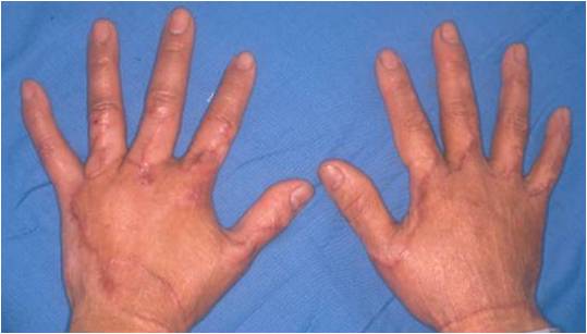 肥厚性瘢痕 術後