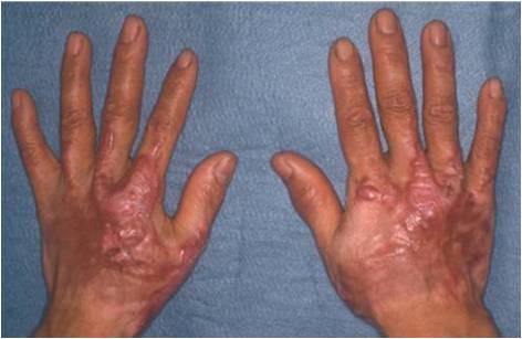 肥厚性瘢痕 術前