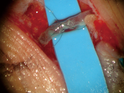 リンパ管と静脈の吻合