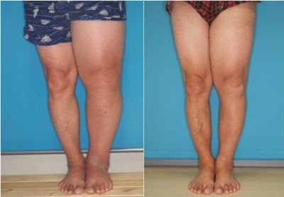 リンパ浮腫の下肢