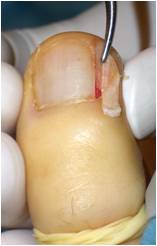 麻酔して爪を抜く