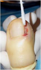 フェノールで爪母を処理