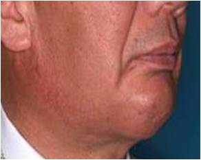 がん治療後の変形 術後