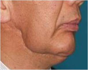 がん治療後の変形 術前