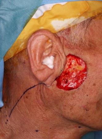 皮膚がん 切除時