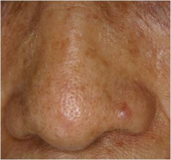 鼻の皮膚病変 1