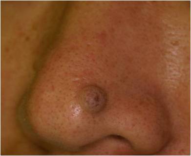 鼻の皮膚病変 2