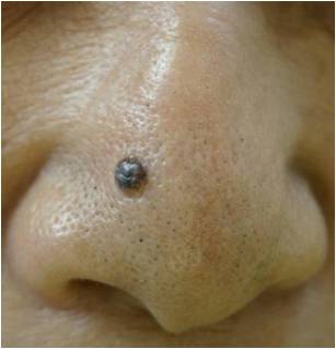 鼻の皮膚病変 3