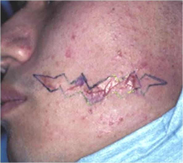 W形成術 デザイン