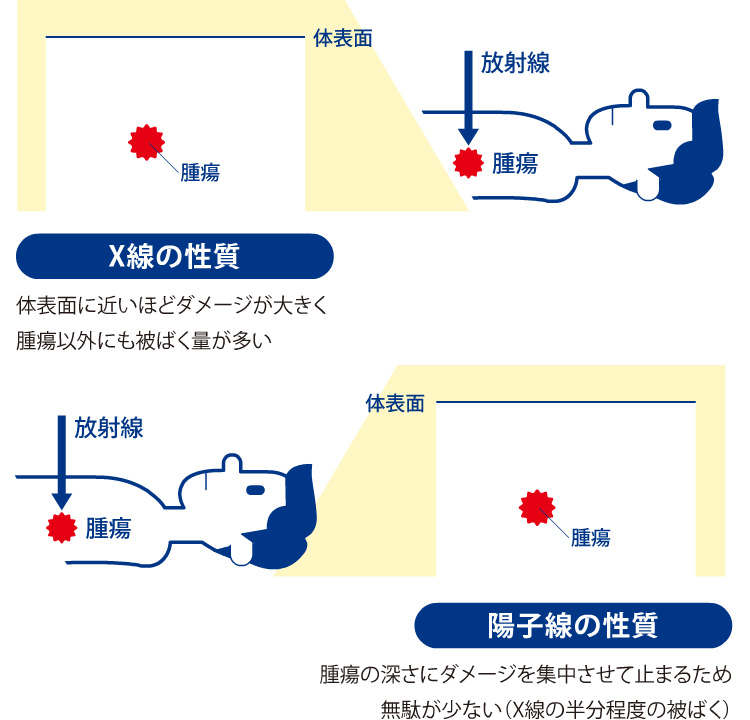【X線の性質】体表面に近いほどダメージが大きく腫瘍以外にも被ばく量が多い　【陽子線の性質】腫瘍の深さにダメージを集中させて止まるため無駄が少ない（X線の半分程度の被ばく）