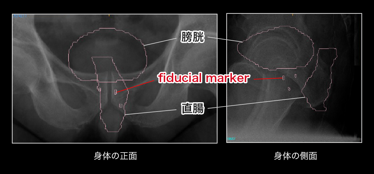 fiducial marker