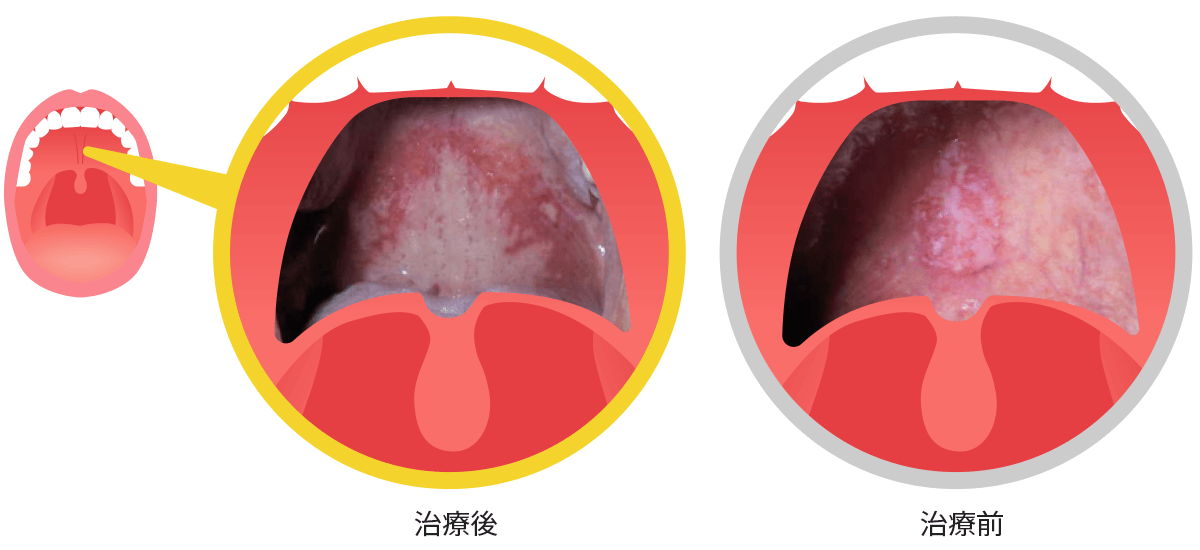 図5 放射性粘膜炎
