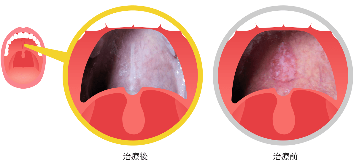 図6 金粘膜炎の消退
