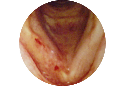 図7　声帯のがん