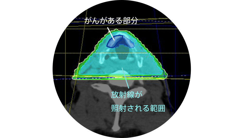 図8 外部照射。がん以外の部分にも広い範囲が照射されている。