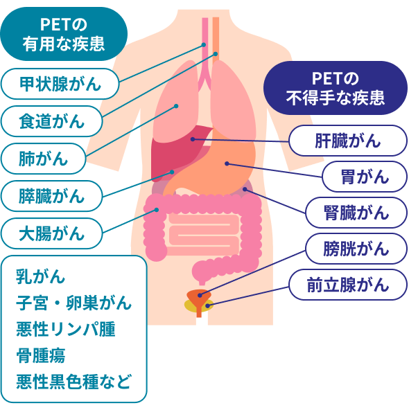 PET-CT検査でがんの早期発見を | 赤穂中央病院